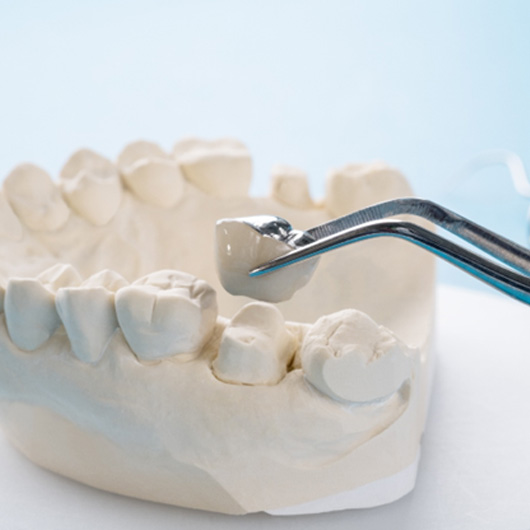 Dental crown and clay model