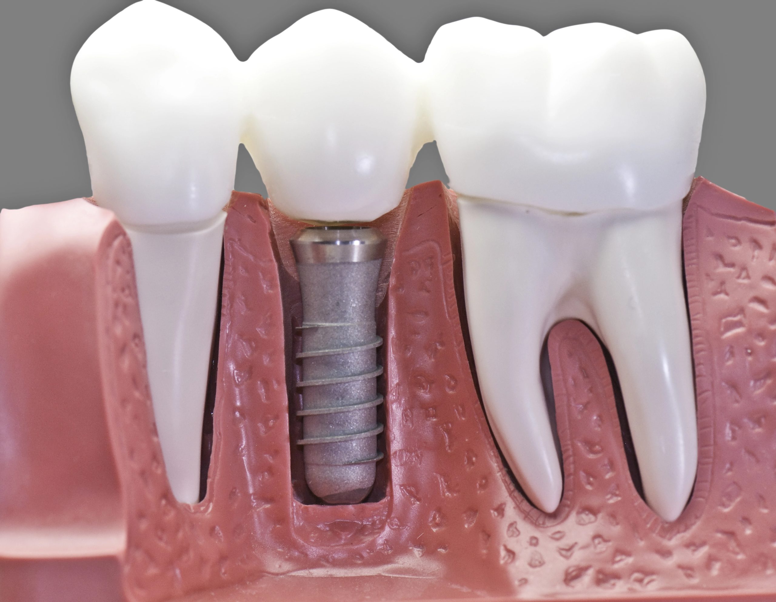 Arlington Heights Dental Implant Restorations