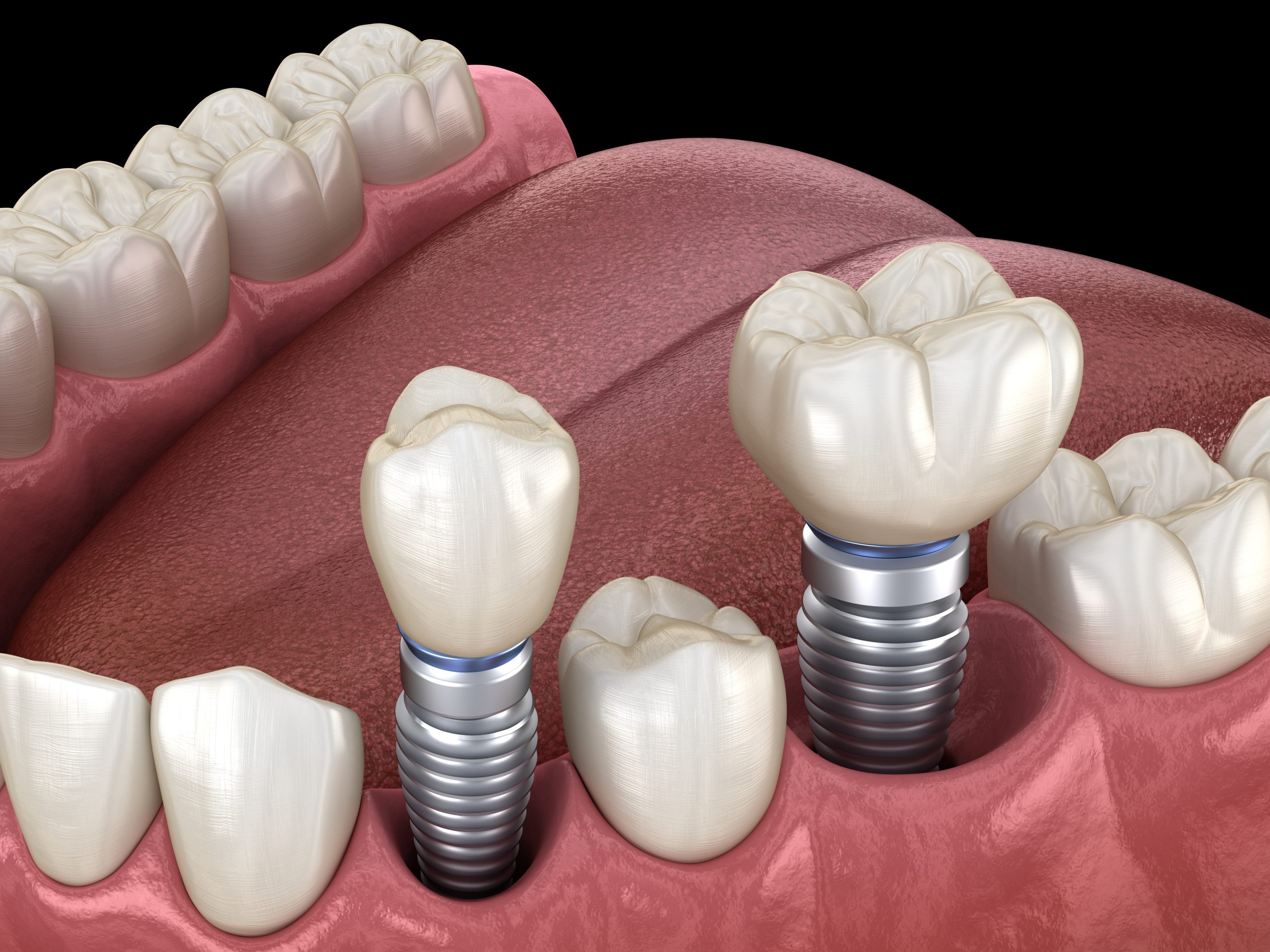 Arlington Heights Dental Crowns